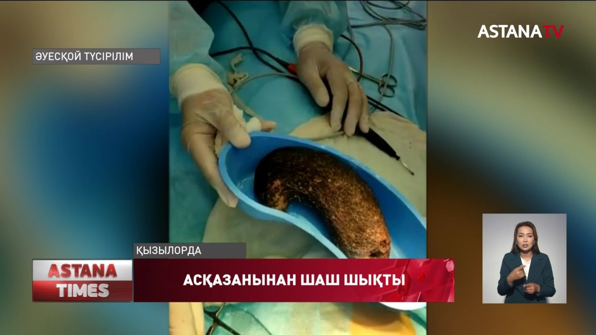 Қызылордада 4 жастағы қыздың асқазанынан жарты келі шаш шықты