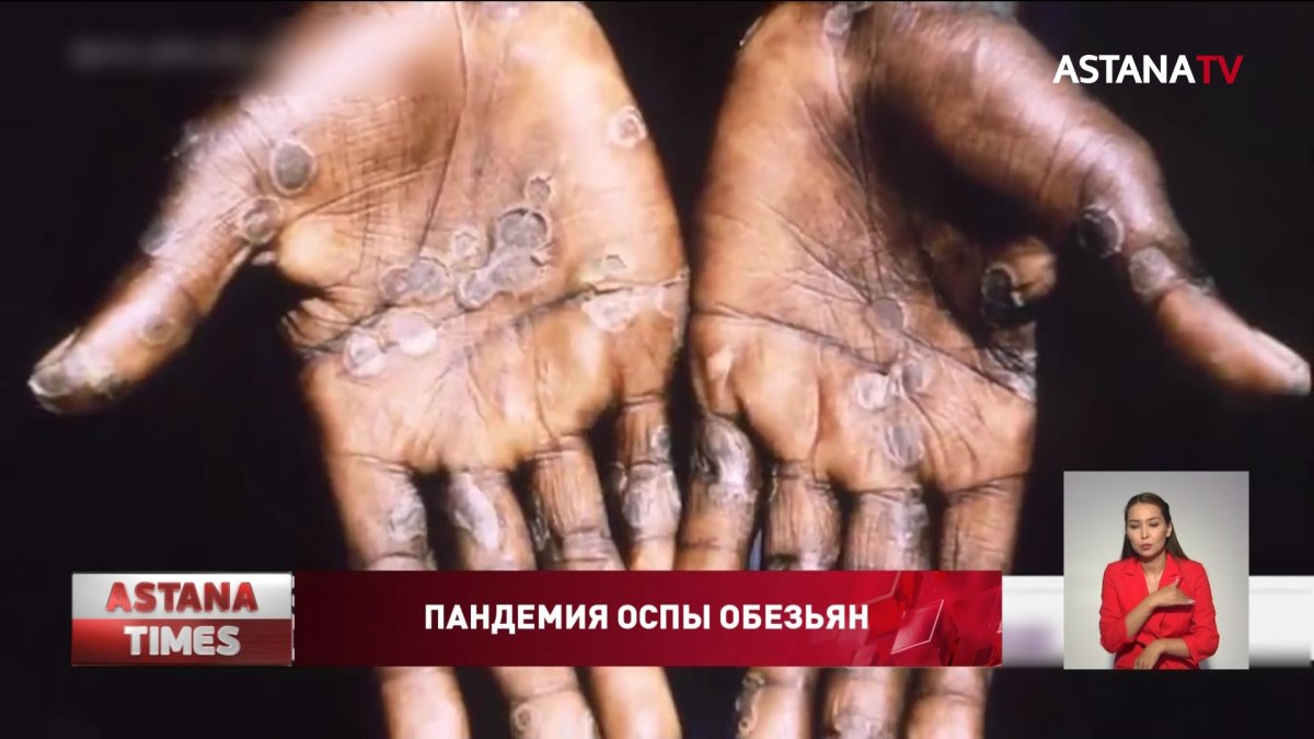 Вспышка оспы обезьян объявлена пандемией