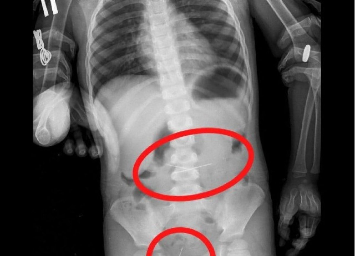 Үш жастағы бала бірнеше инені жұтып қойған