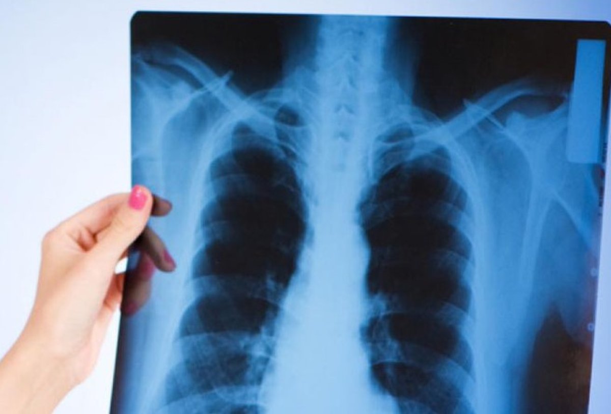 Туберкулезом стали чаще заражаться шымкентские школьники