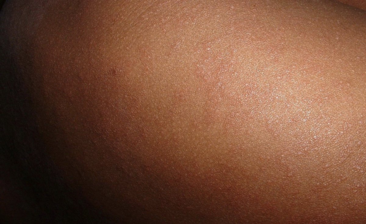 13 тысяч казахстанцев заразились корью: Гиният бьет тревогу