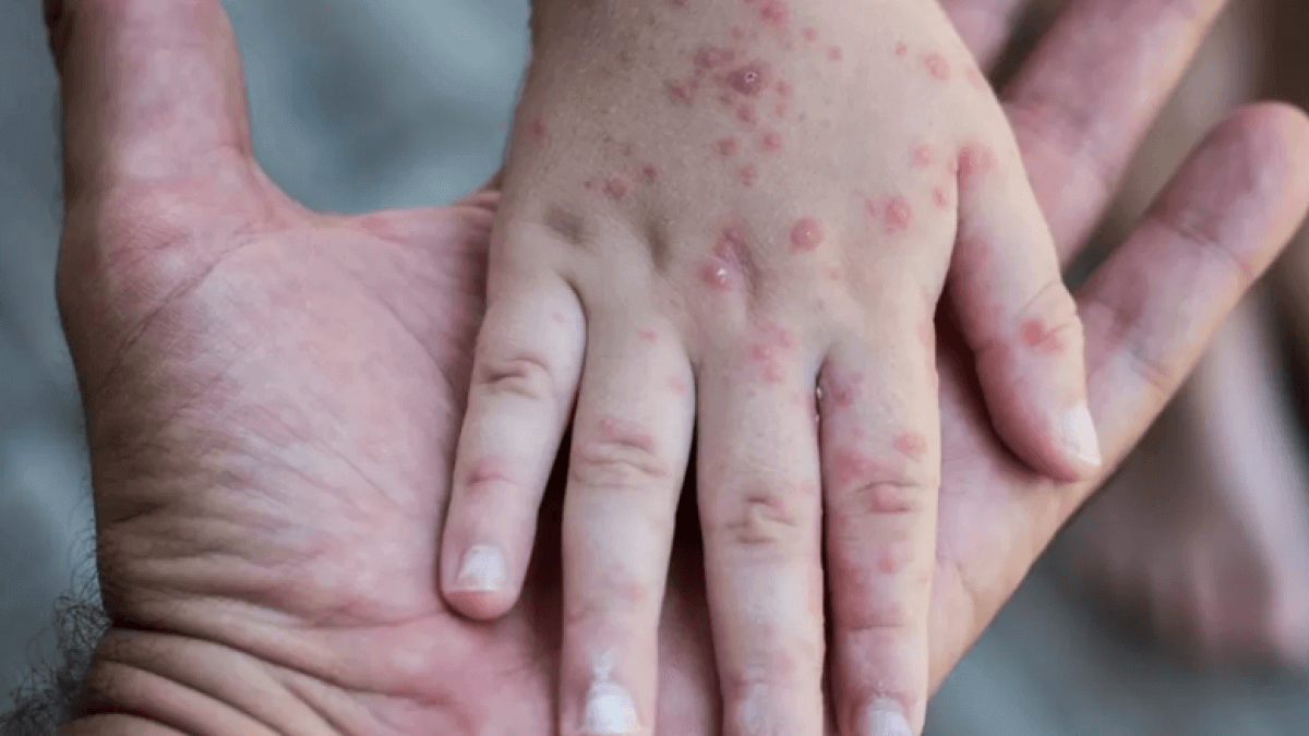 Қазақстан қызылша ауруы бойынша 1-орында тұр - БҰҰ