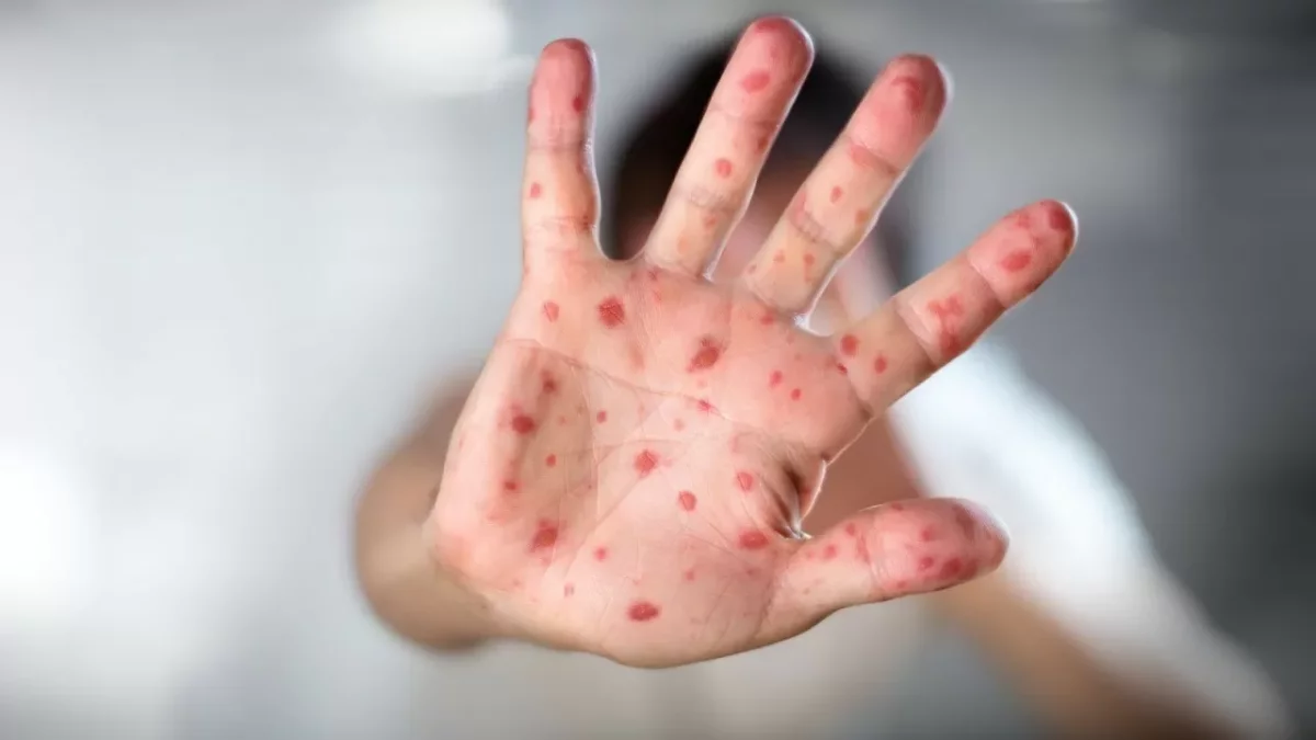 Казахстан попал в список стран с самой высокой заболеваемостью корью