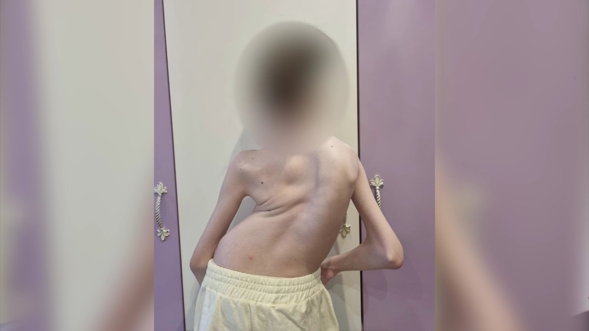 Алматыда омыртқасы 140 градусқа қисайған балаға күрделі операция жасалды