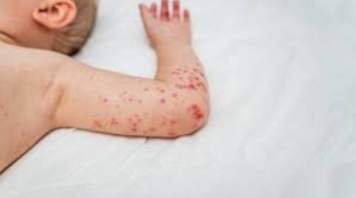 Полугодовалый ребенок умер от кори в Восточном Казахстане