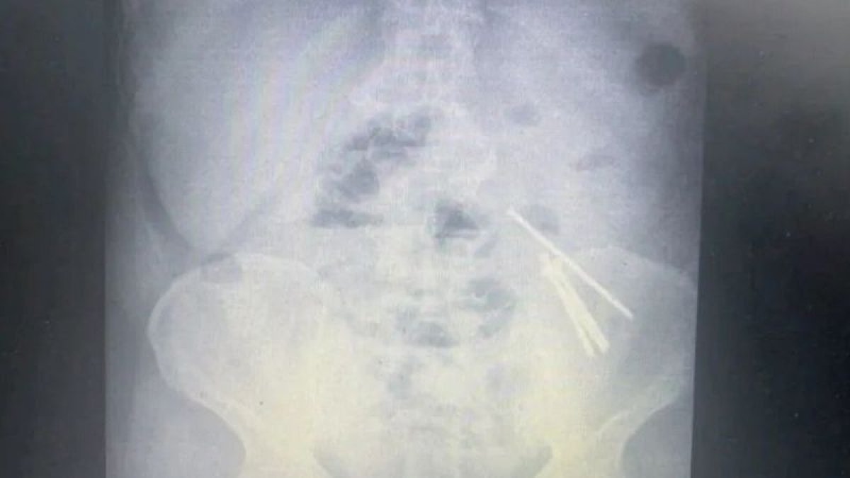 Алматы облысында ер адам өз-өзіне қол жұмсамақ болып, екі рет шеге жұтқан