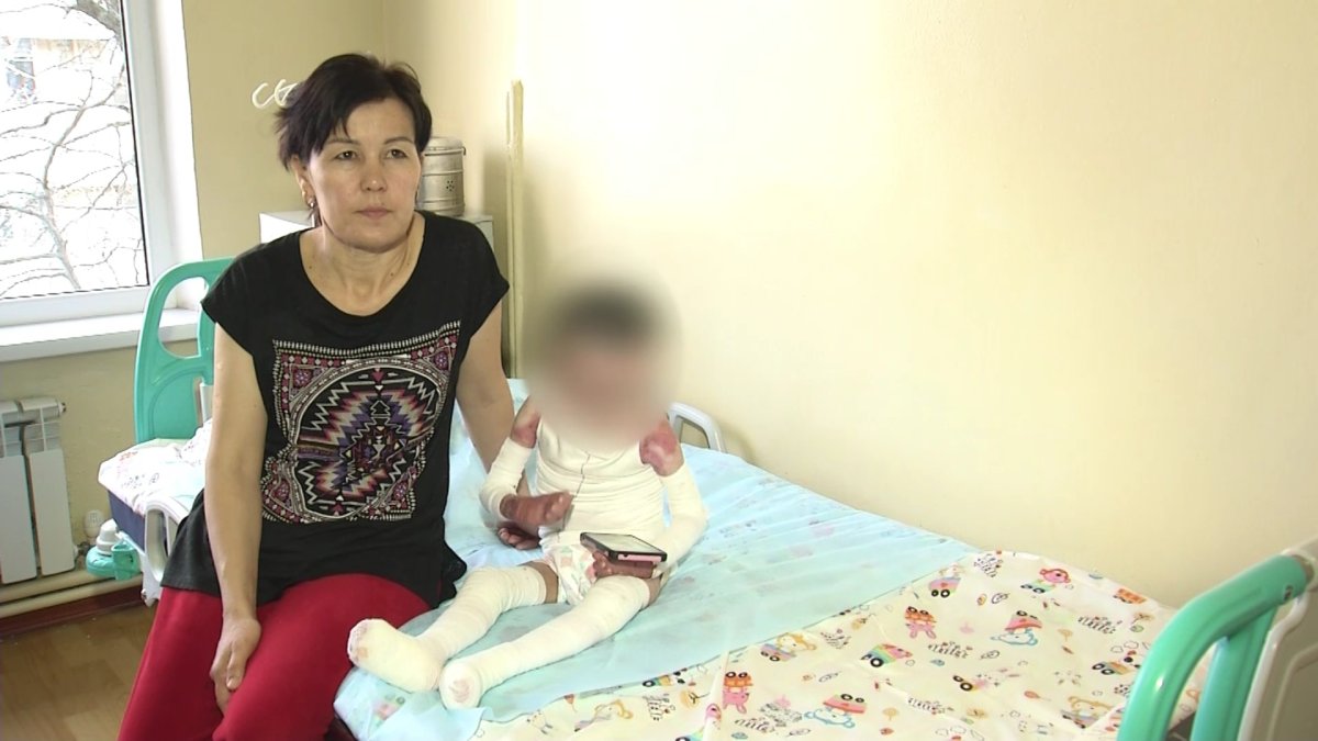 "Ювелирную" операцию по разъединению пальцев рук и ног провели детям-"бабочкам" в Алматы