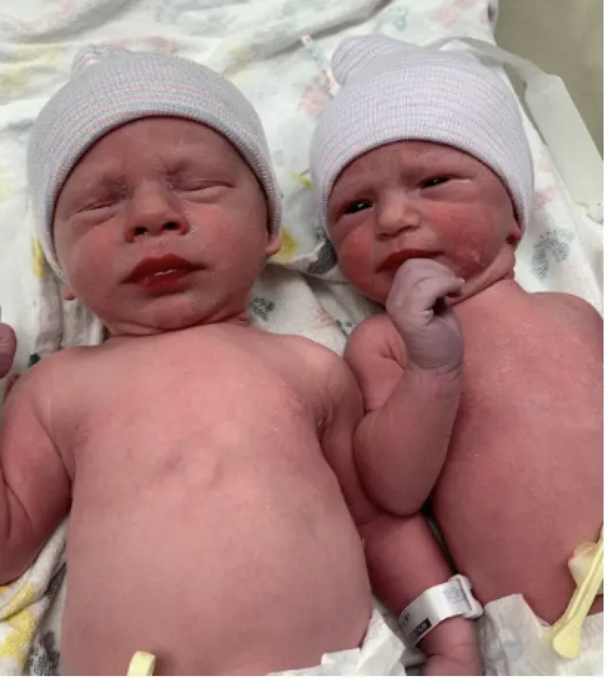 Зачатые 30 лет назад близнецы появились на свет