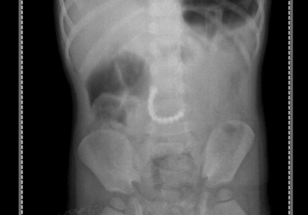 11 магнитиков извлекли из желудка малыша карагандинские врачи