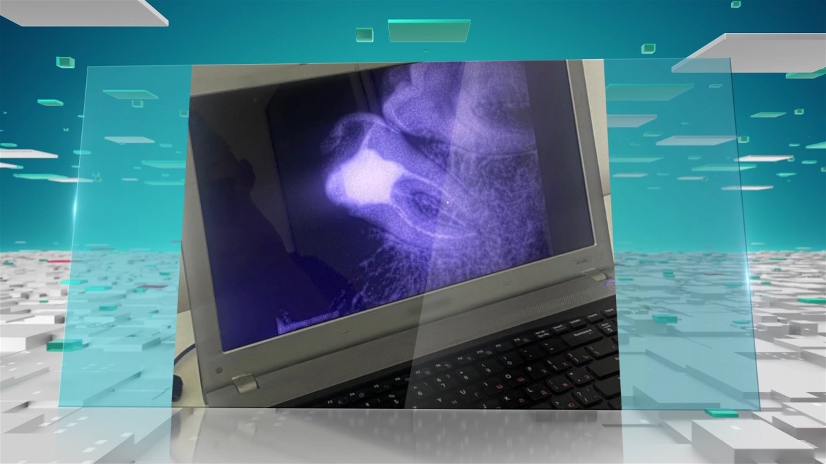 Астаналық тұрғынның тісінде дәрігердің екі құралы қалып қойған