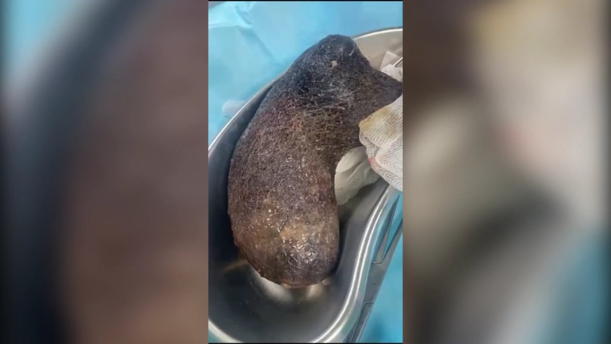 Килограмм волос извлекли из желудка ребёнка в Алматы