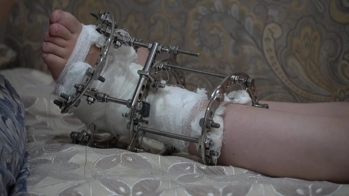 «Табанына жара шығып, сүйегі шіріп жатыр»: ауыр дертке шалдыққан 14 жастағы Настяның еміне қаржы керек