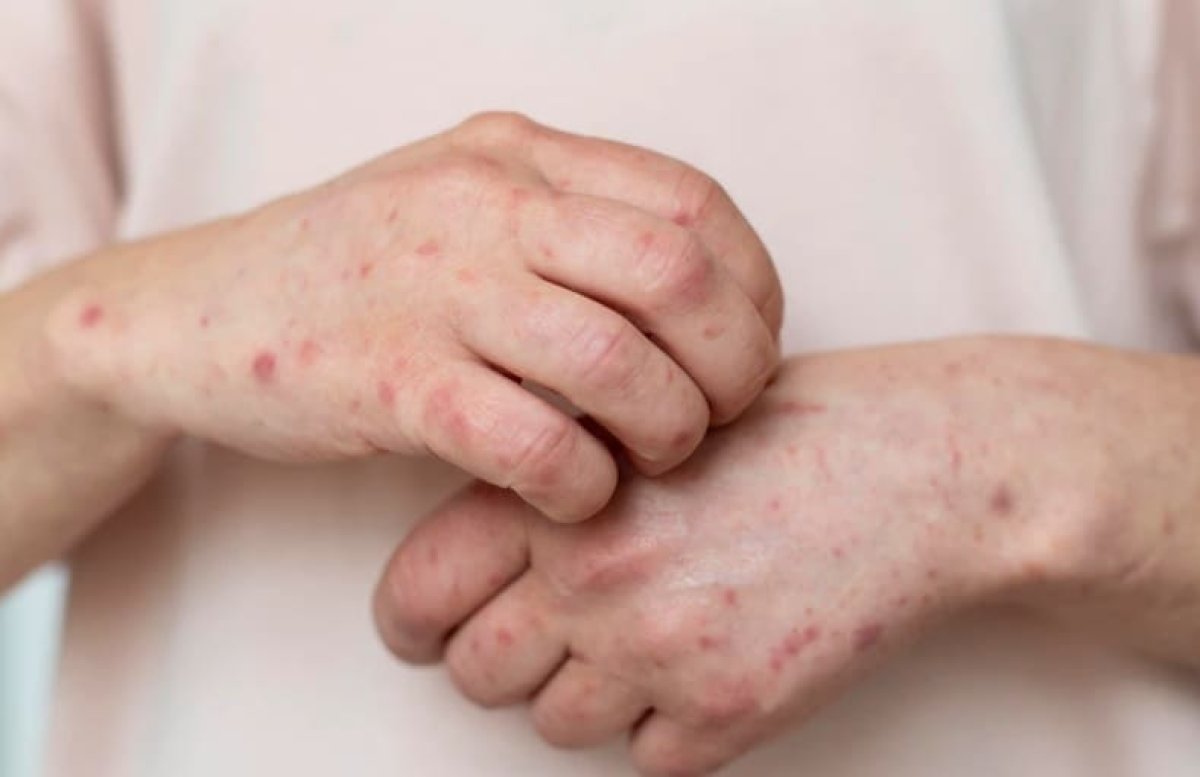 Эпидситуация по кори осложнилась в Астане