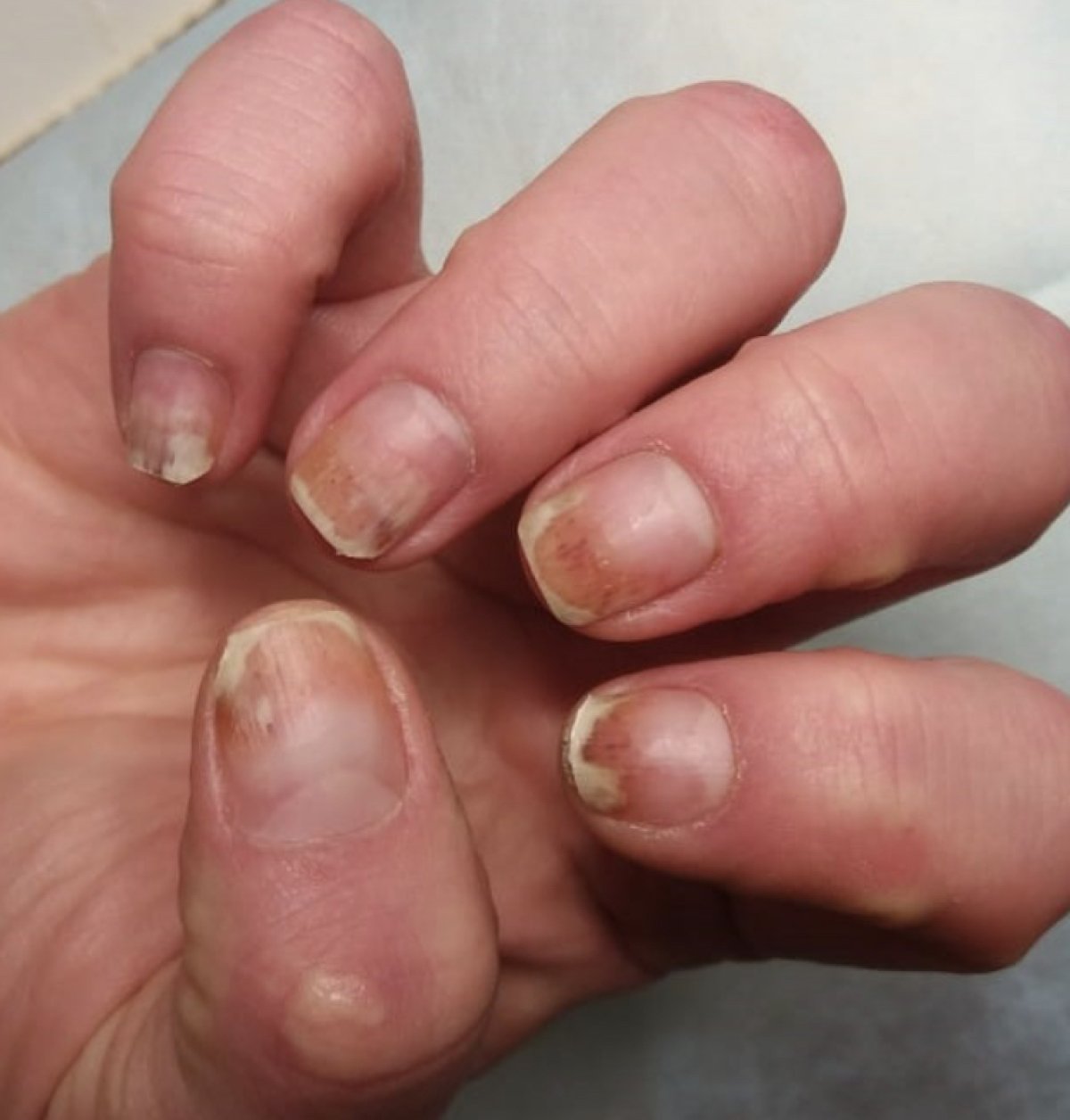 Жительница Уральска не смогла доказать в суде ожог ногтевой пластины из-за маникюра