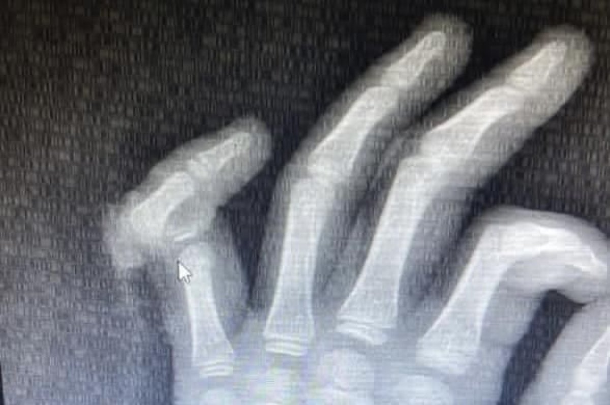 Оторванный палец пришили ребёнку в Алматы