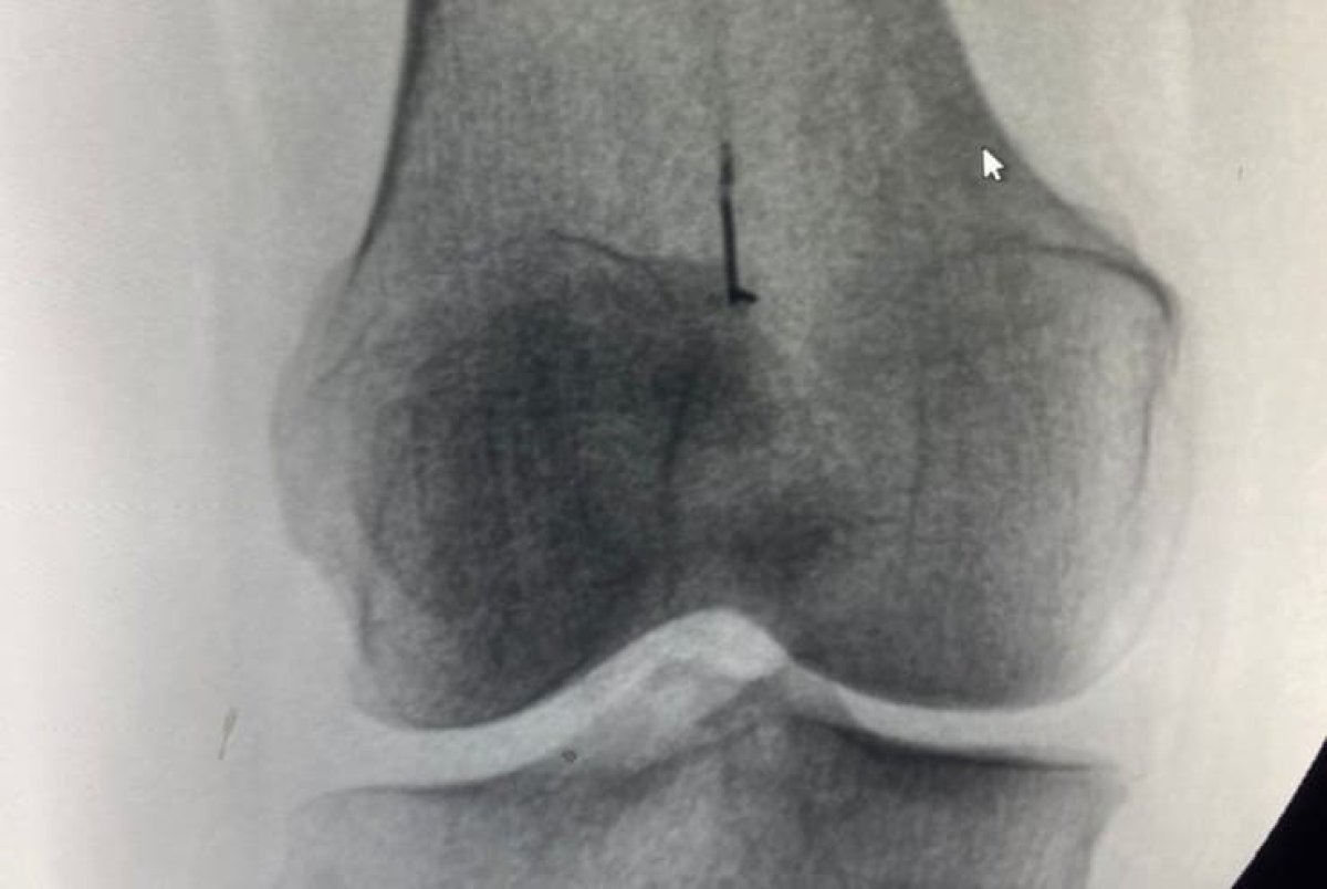 45 лет с иголкой в колене проходила алматинка