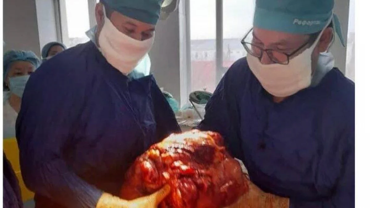 Атырауда дәрігерлергер науқастан 15 келілік ісік алды