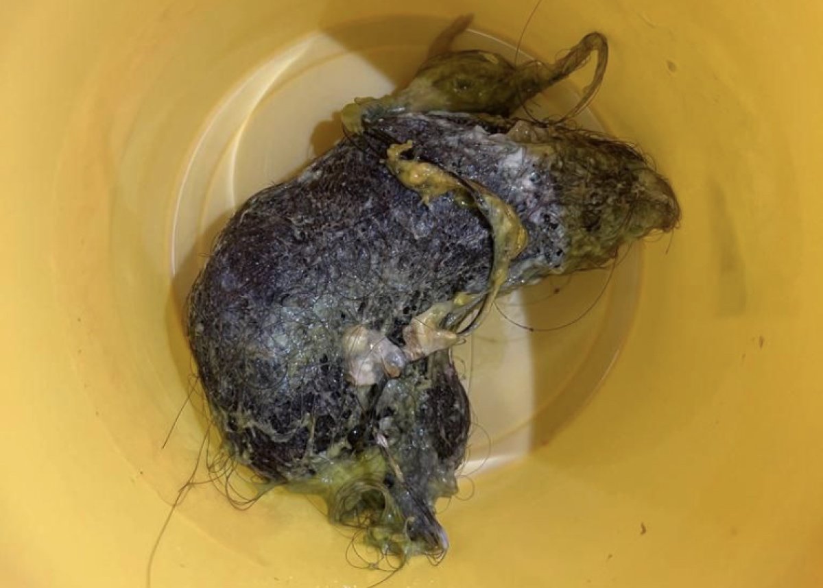 Килограммовый ком волос извлекли из желудка подростка в Таразе