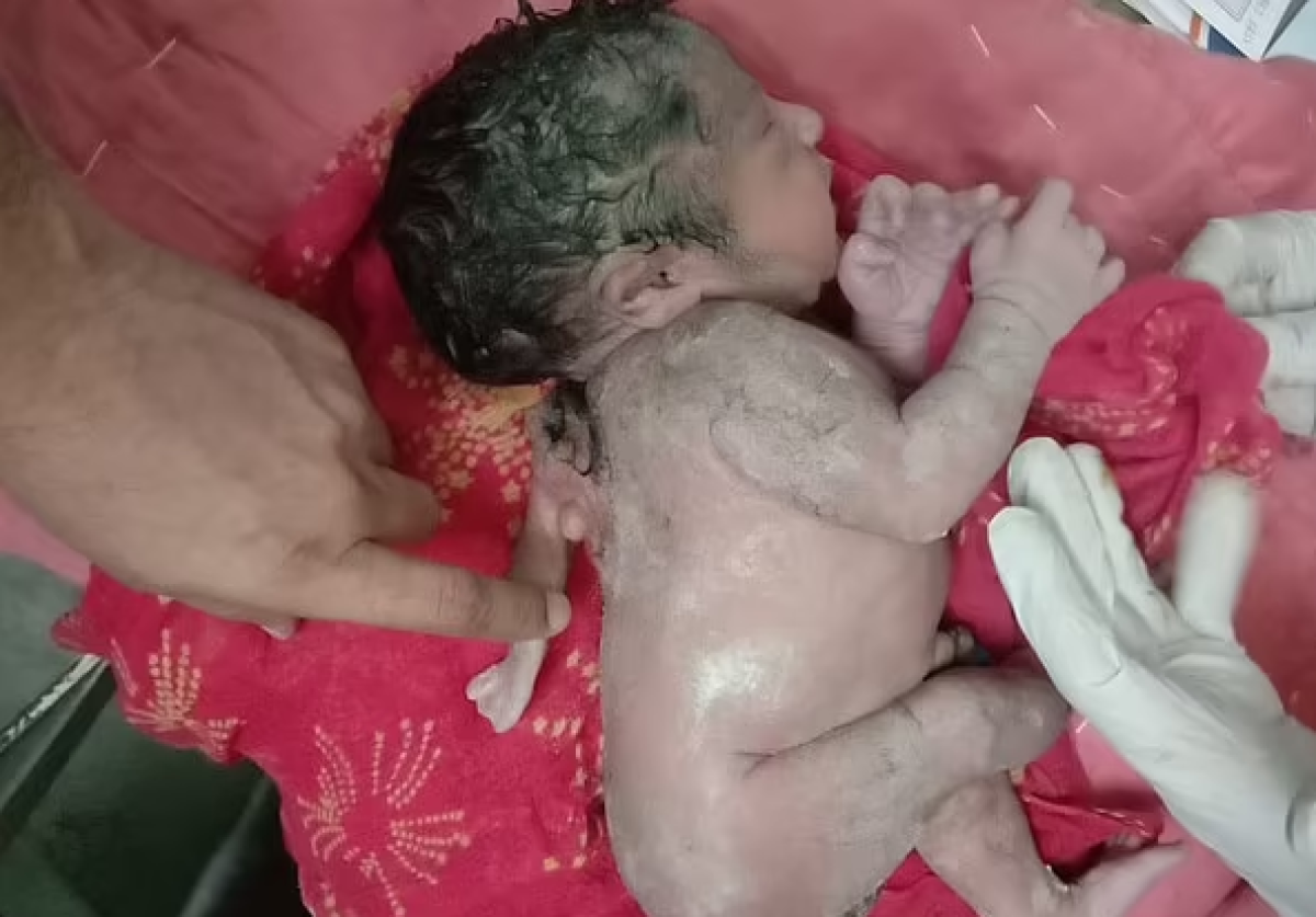Ребенок с тремя руками родился в Индии