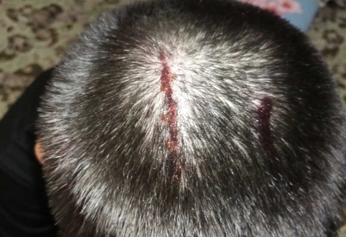 Подросток рассёк голову на спортплощадке в Костанае