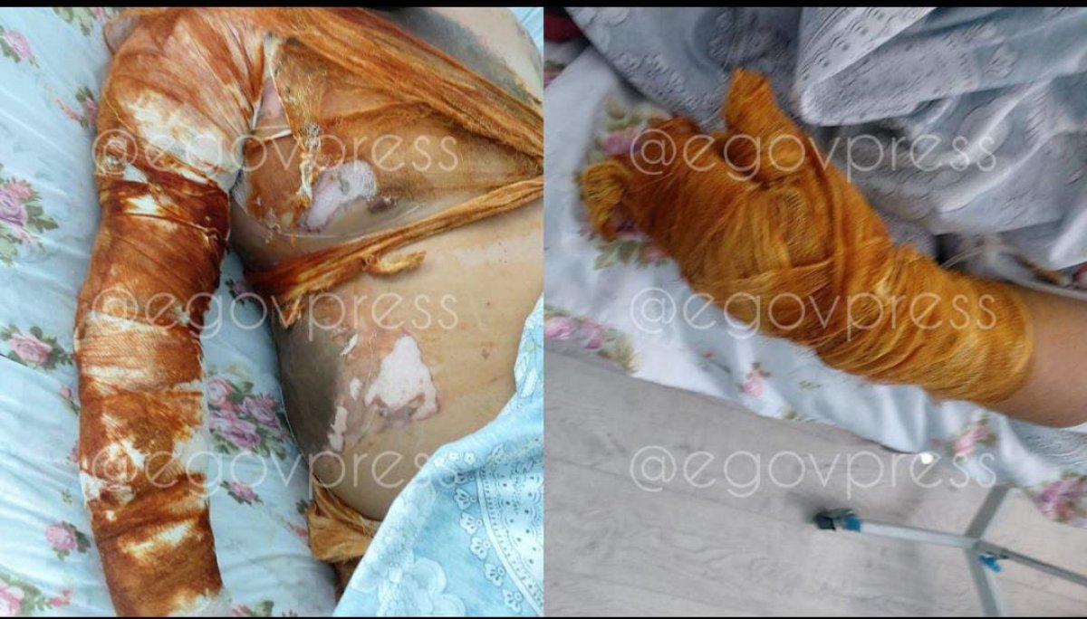 Үш жұмысшы күкірт қышқылына күйіп қалды