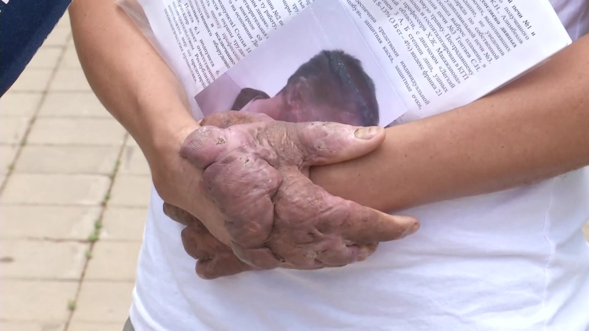 Карагандинец лишился рук и лица из-за травмы на производстве