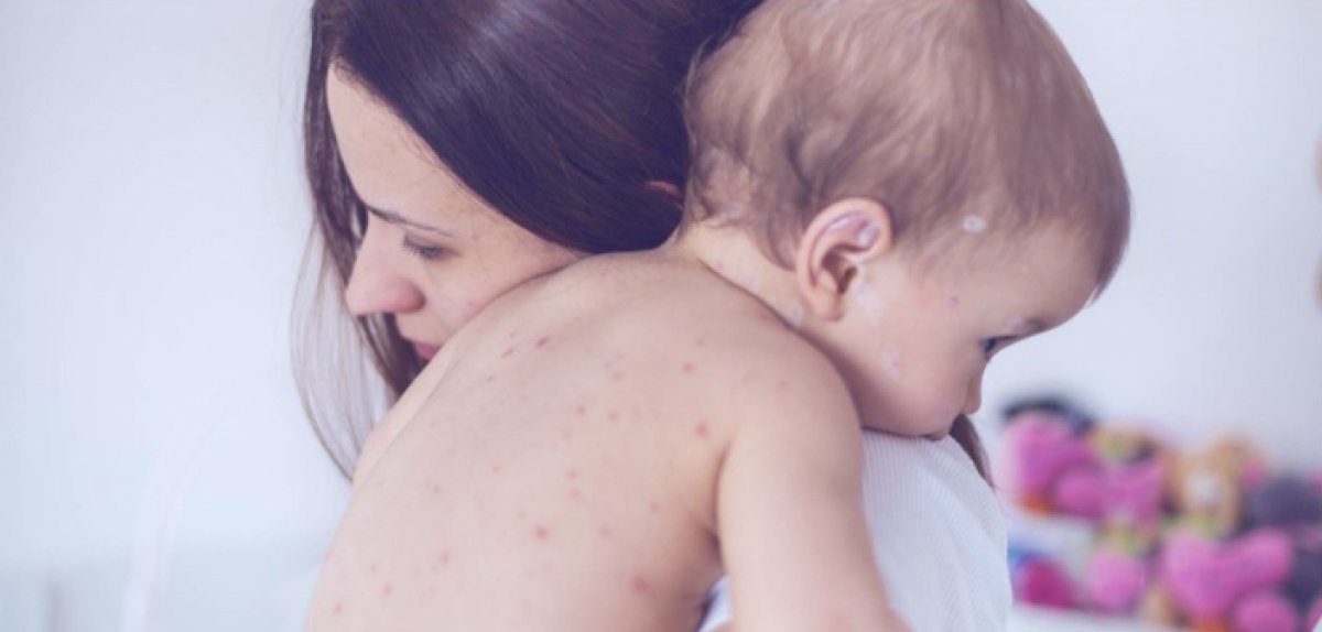 Семилетний ребёнок из ВКО заразился корью в Турции