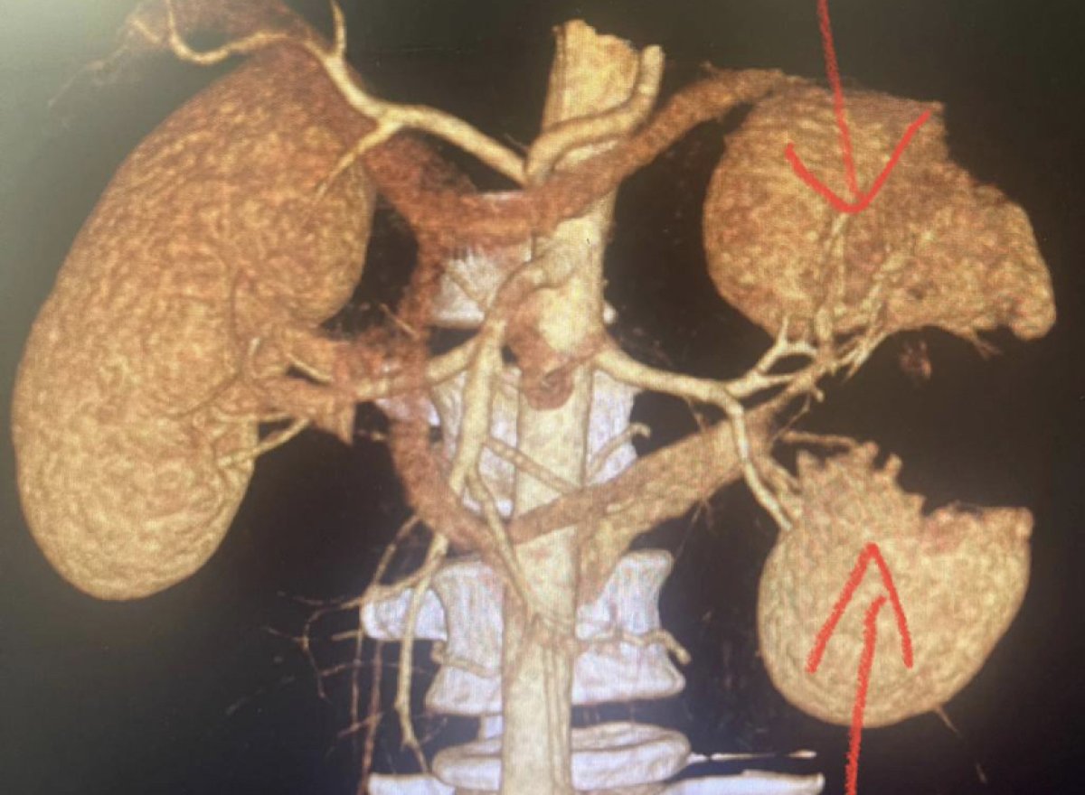 Россиянин лишился почки после падения с самоката