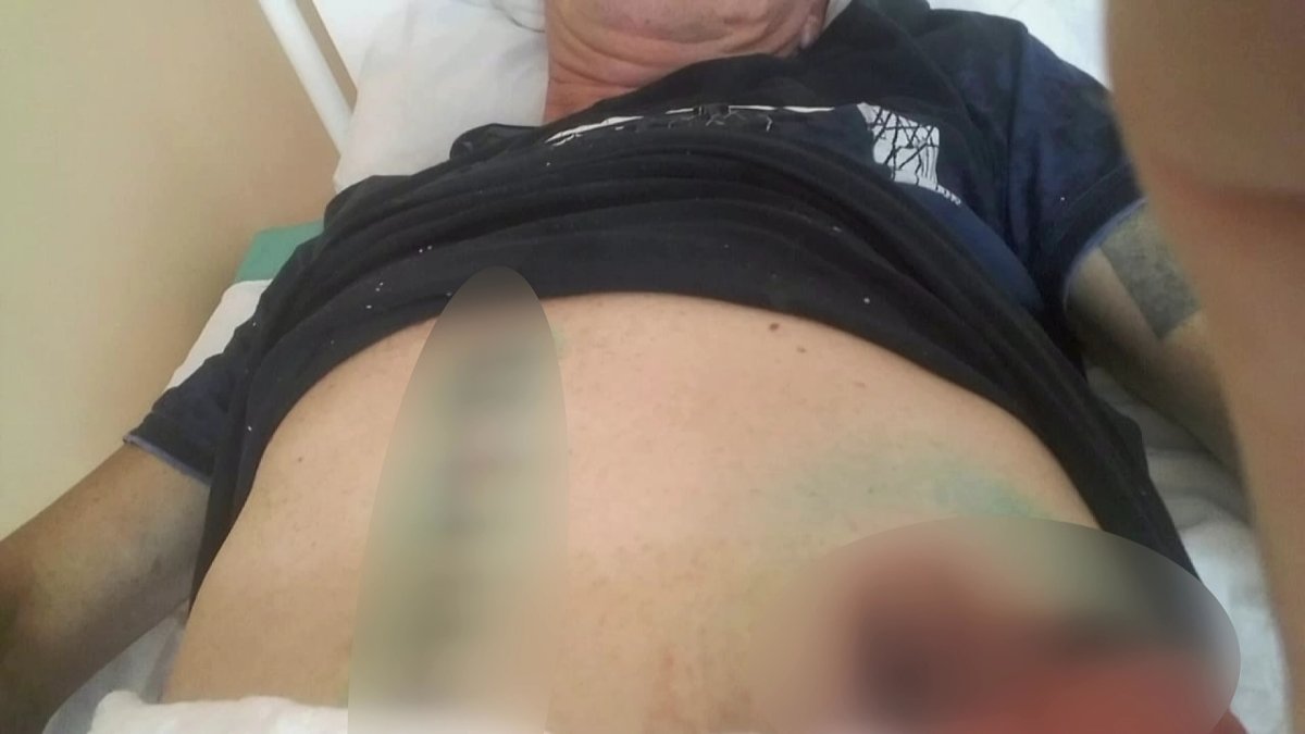 Удалили селезенку и почку: сельчанин обвиняет полицейских в жестоком избиении в СКО