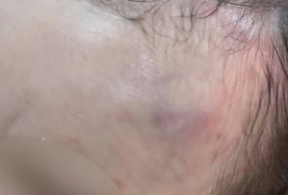 Ребёнок вернулся из детского сада в Павлодаре с гематомами