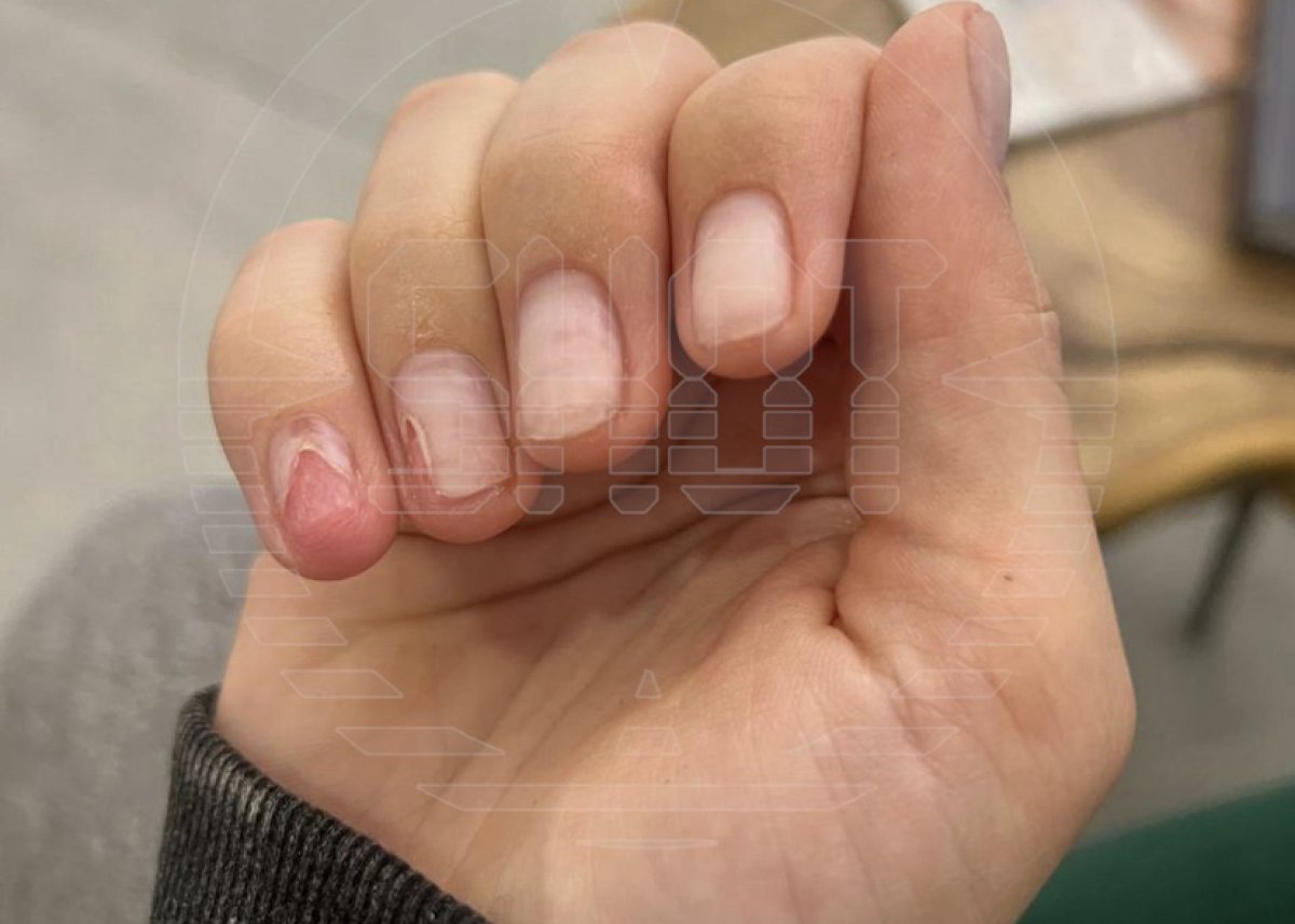 Гель-лак разъел ногтевые пластины девушки