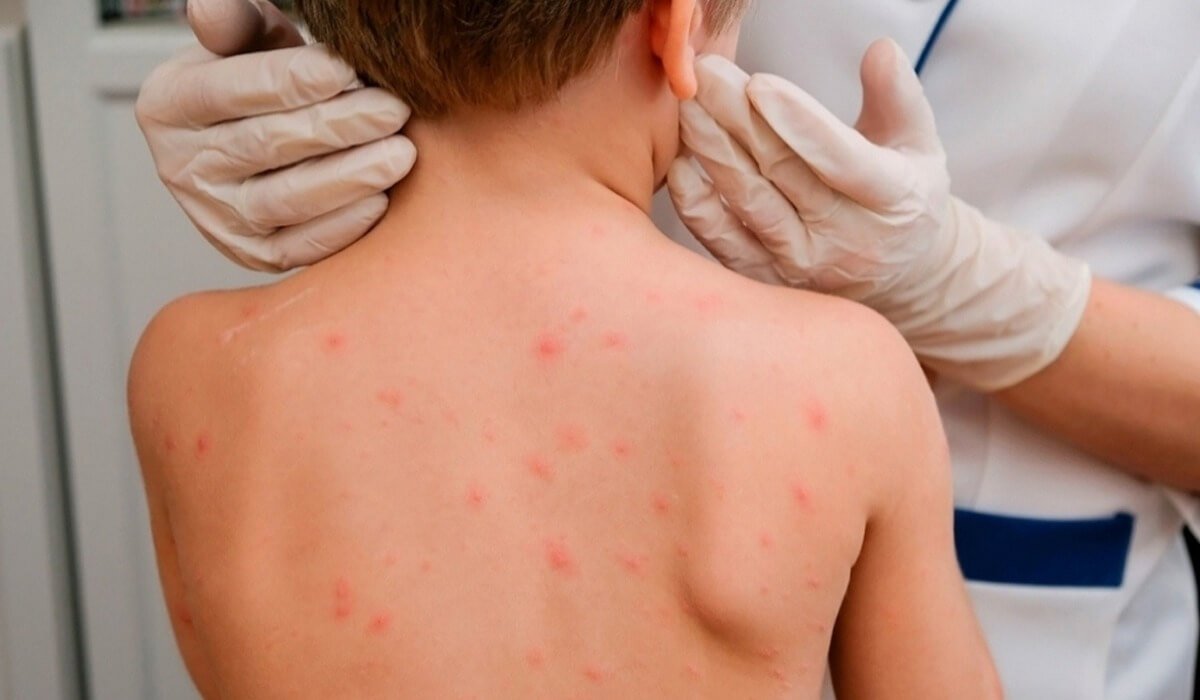 Елімізде қызылша ауруы дендеп барады