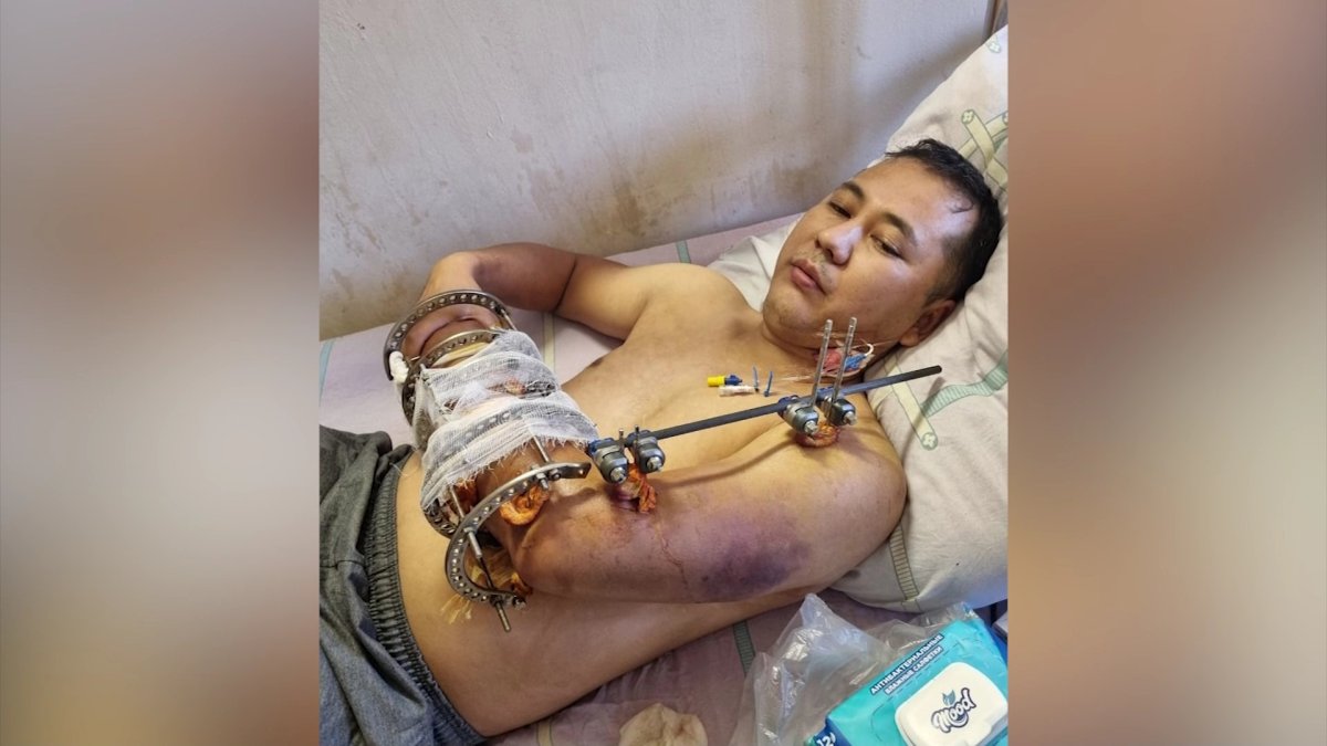 Алматыда өндіріс орнында жарақат алған жұмысшы қолынан айырылды