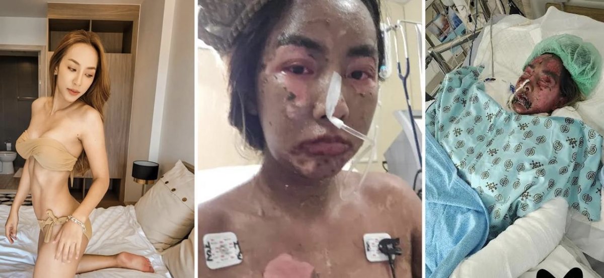 Блогер потеряла зрение и половину кожи, а затем впала в кому из-за антибиотика