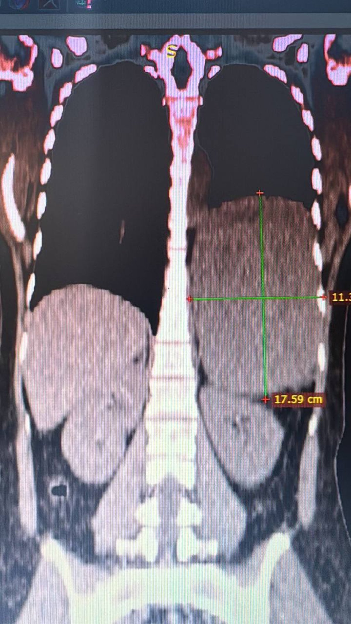 Алматинке удалили гигантскую опухоль диафрагмы