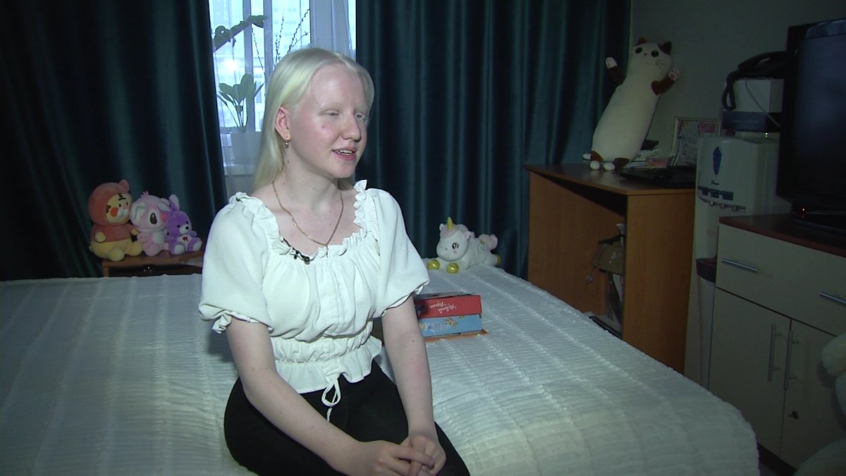 Альбинизм: ғажайып сый ма, әлде ауыр тағдыр ма?