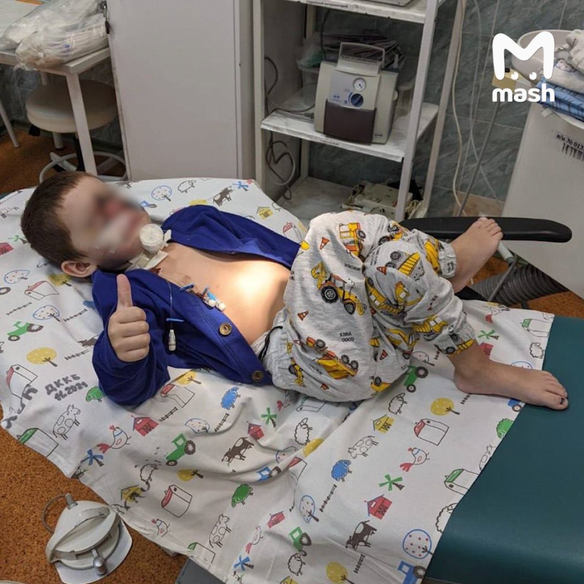 Хирурги пришили ребёнку лицо, откушенное собакой