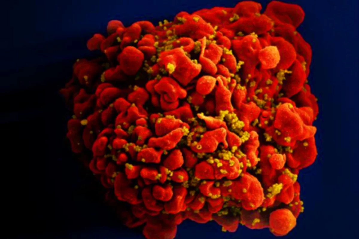 Германияда 60 жастағы науқас ВИЧ инфекциясынан емделіп шықты