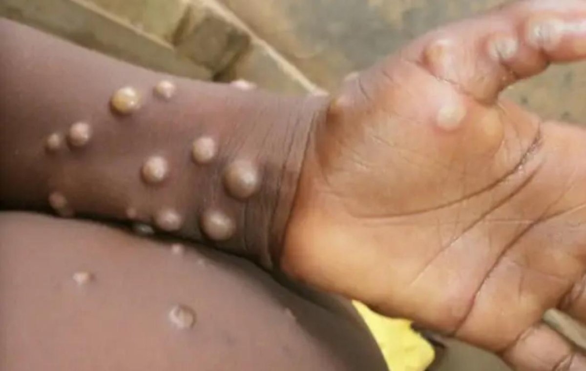 Елімізге маймыл шешегі еніп кетпес үшін қандай шаралар жасалып жатыр