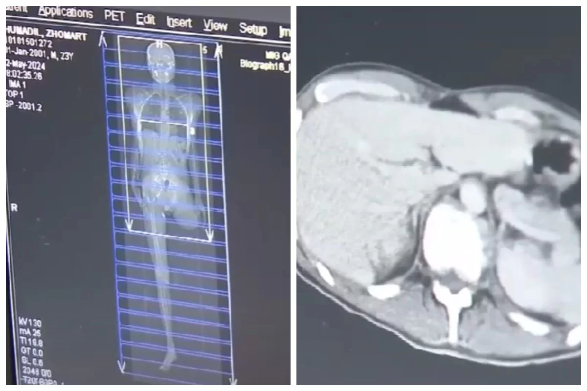 Коронавирус инфекциясынан кейін кәмелет жасына толмаған балалардың миы қартайып кеткен