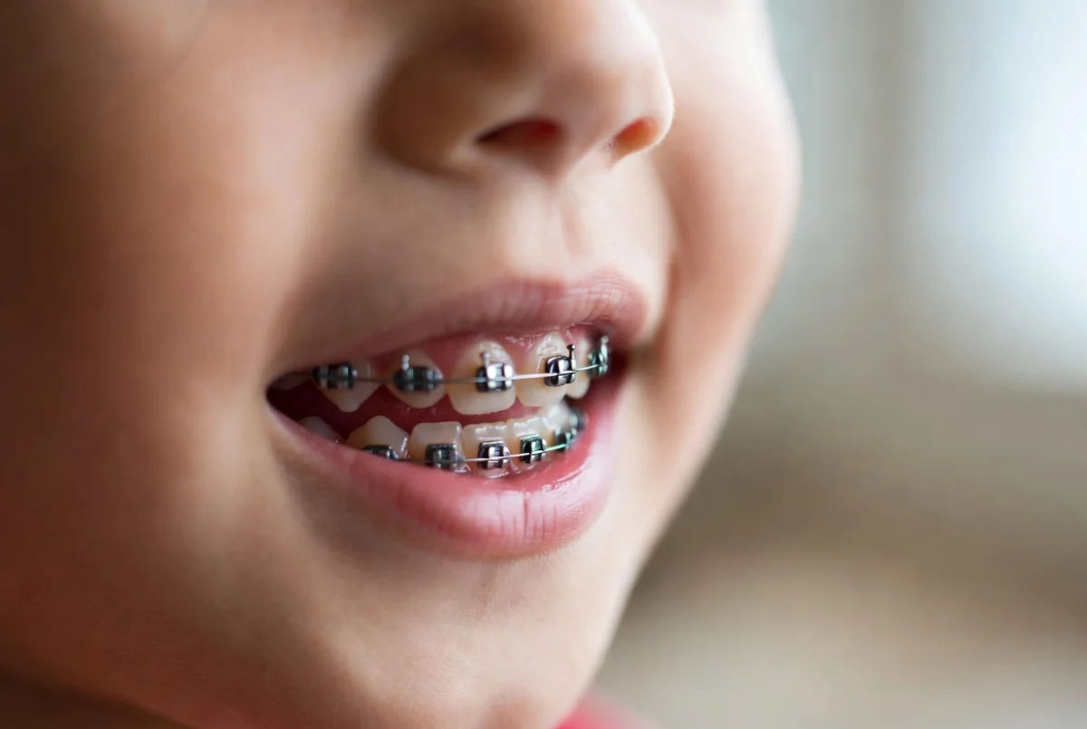 Слух про бесплатные брекеты детям по ОСМС не подтвердился - ФСМС дала разъяснение