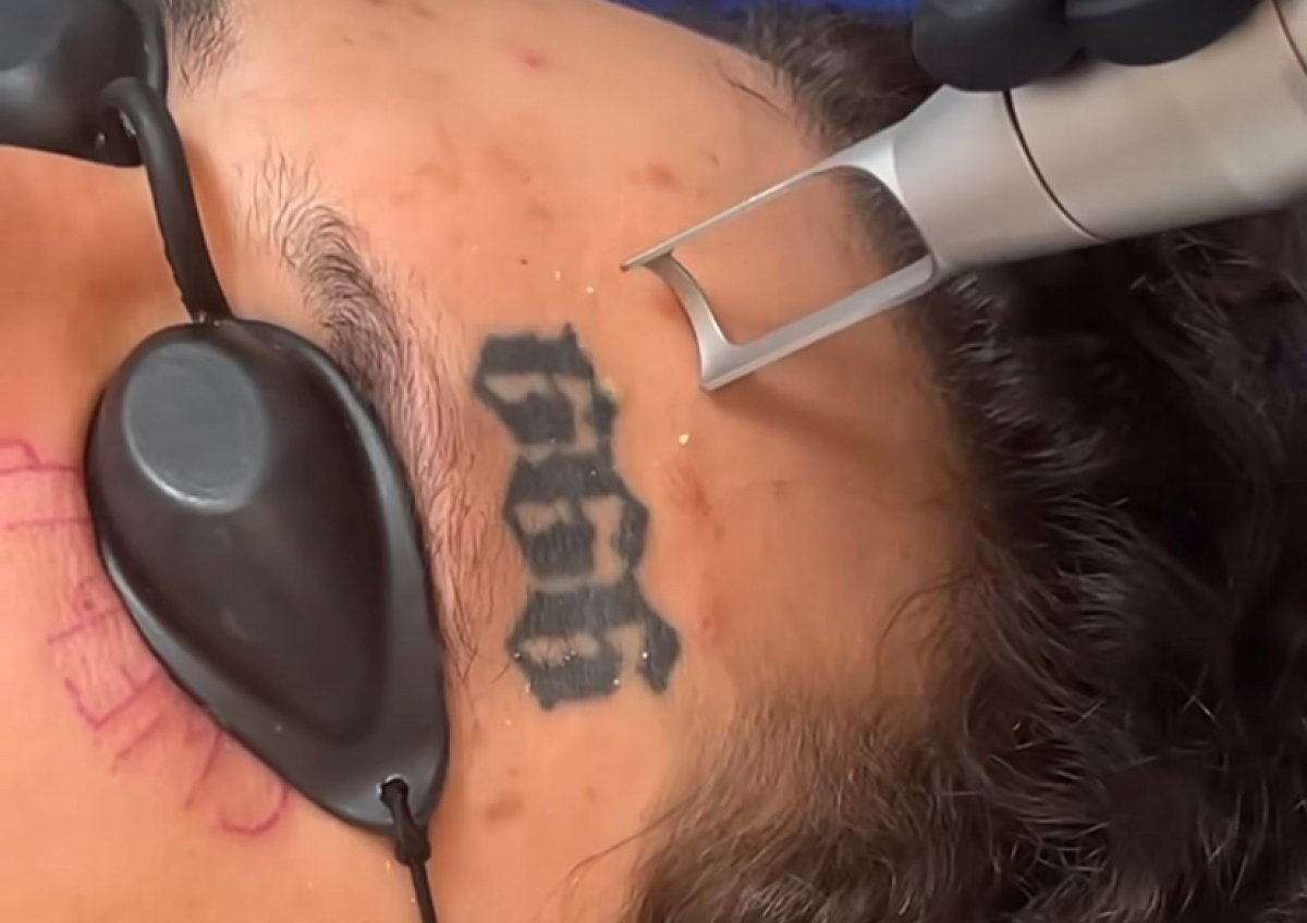 С чистого лица: Моргенштерн удаляет тату (ВИДЕО)