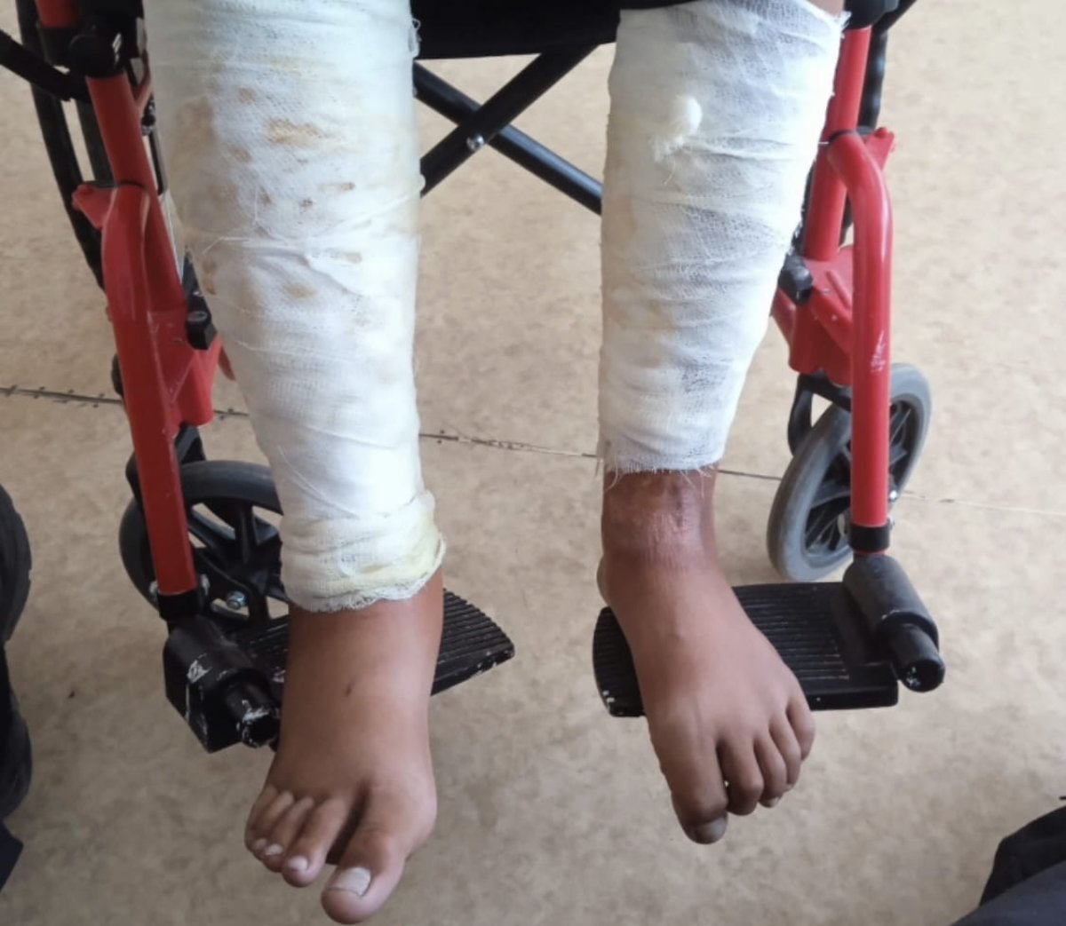 Подросток поджег приятеля в Карагандинской области