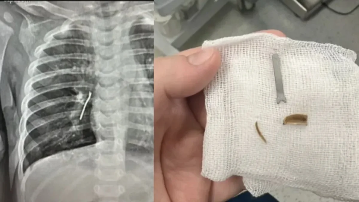 Ребёнка в Актау лечили от астмы из-за скорлупы семечек в легких