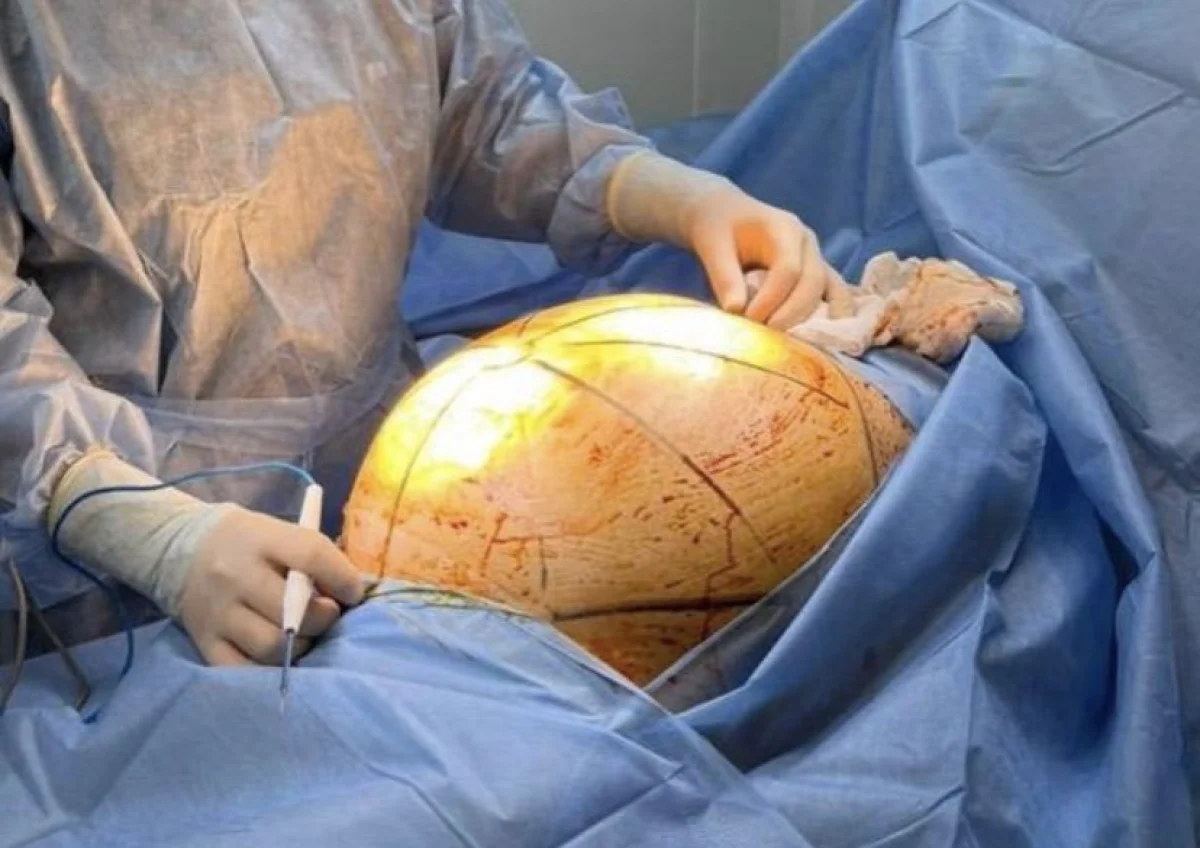 Женщина лечилась БАДами — в итоге опухоль выросла до 55 см: её спасли врачи Алматы