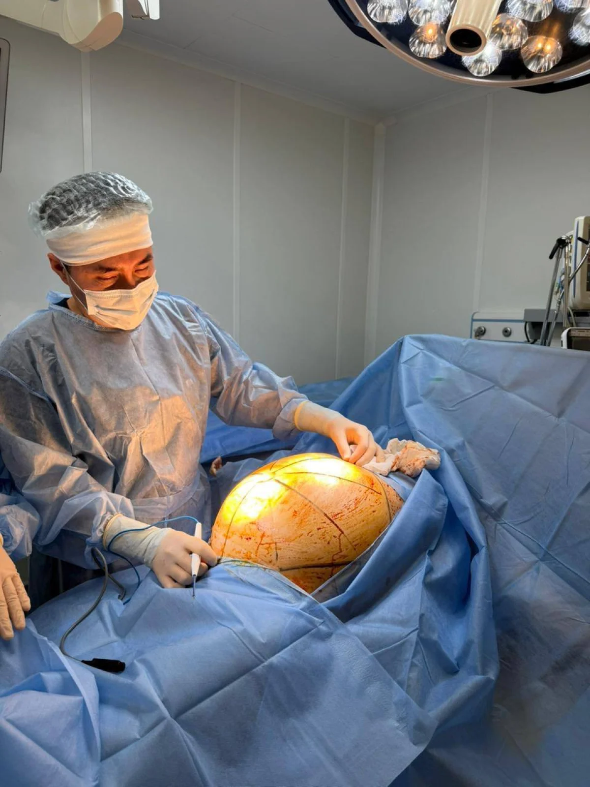 Алматыда дәрігерлер 25 келілік ісікті алып тастады