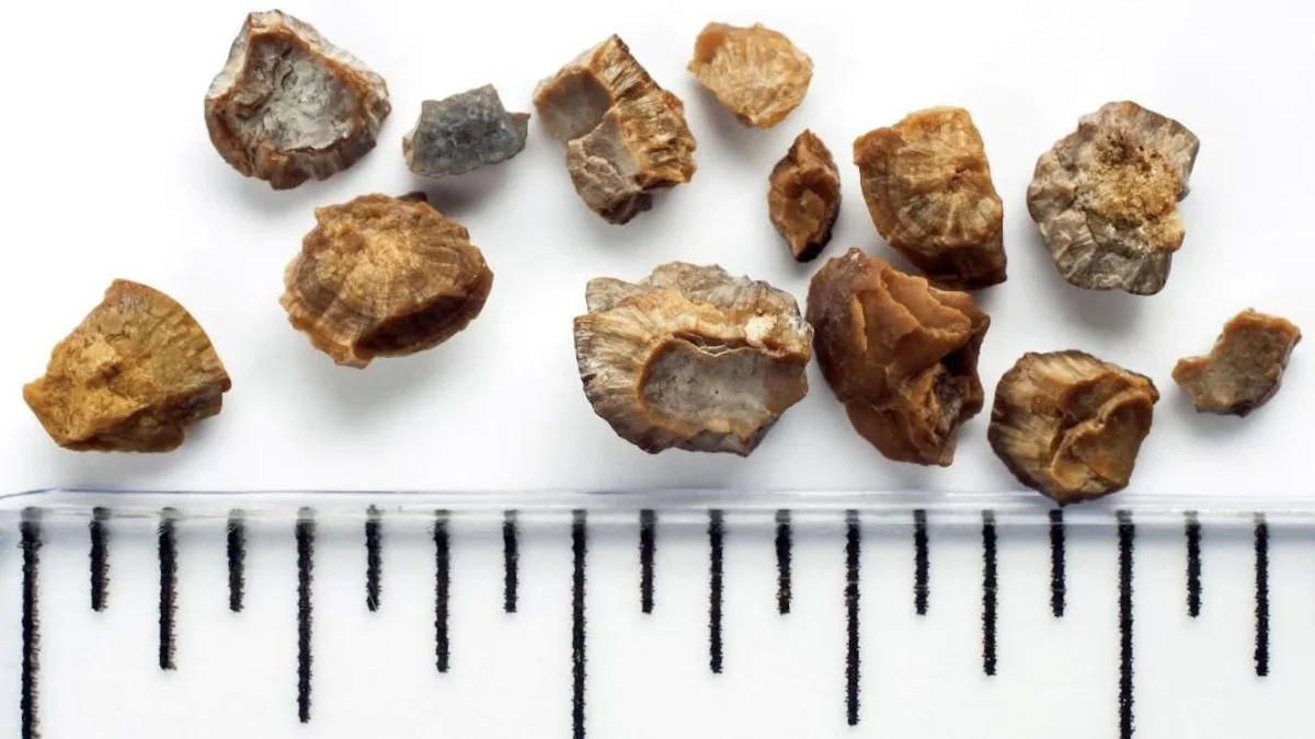 Обильное питье не спасает от образования камней в почках, - исследование