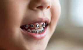 Слух про бесплатные брекеты детям по ОСМС не подтвердился - ФСМС дала разъяснение