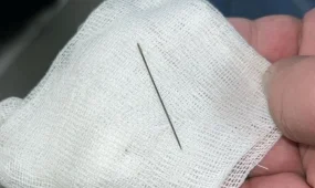 8 айлық сәбидің ішінен ине шықты