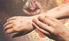 Қазақстанда маймыл шешегінің кеңінен таралу қаупі бар ма?